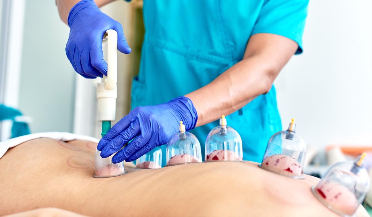 Hijama therapy image 1